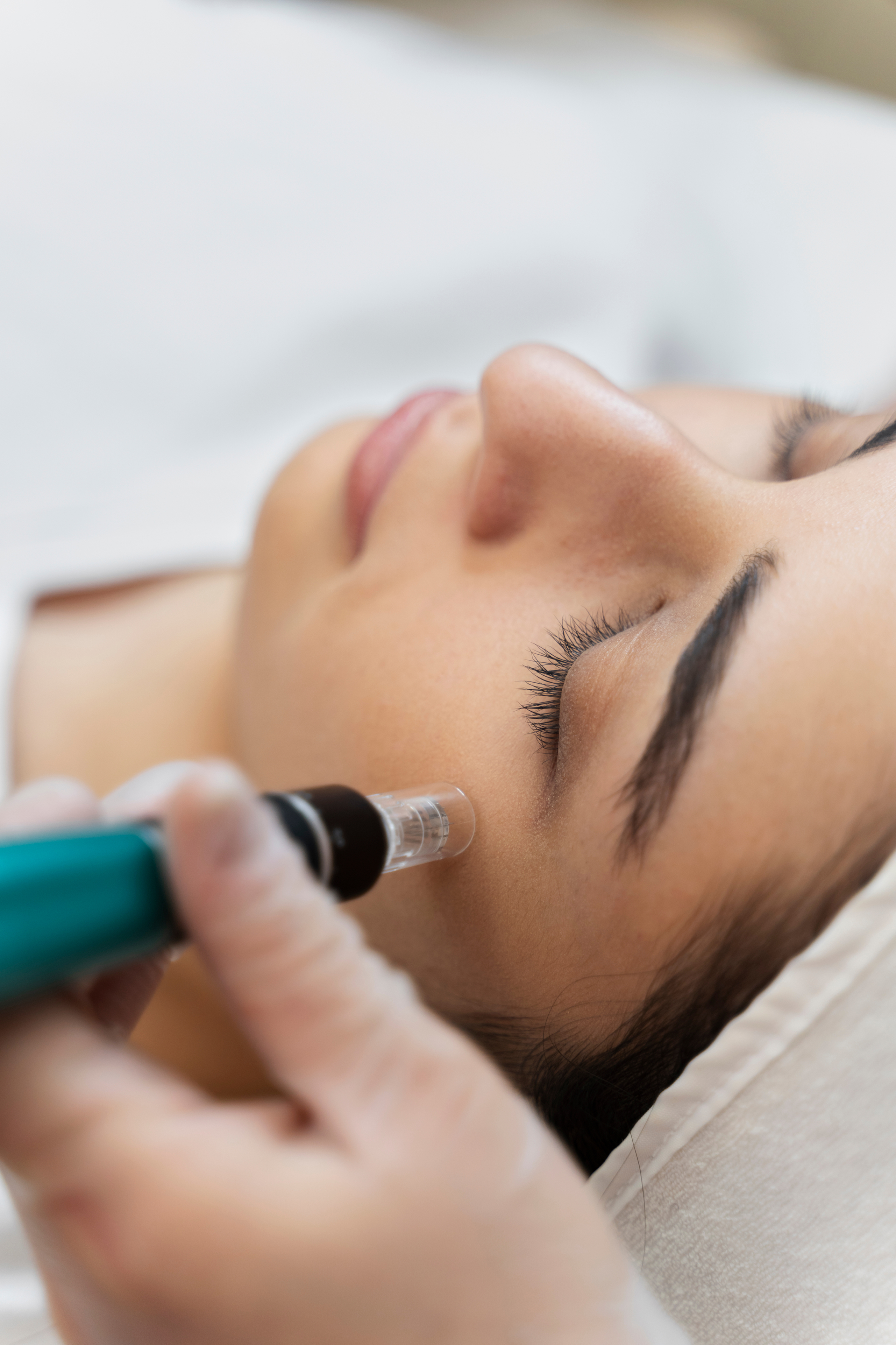 Vilight Beauty — One Face Microneedling Session